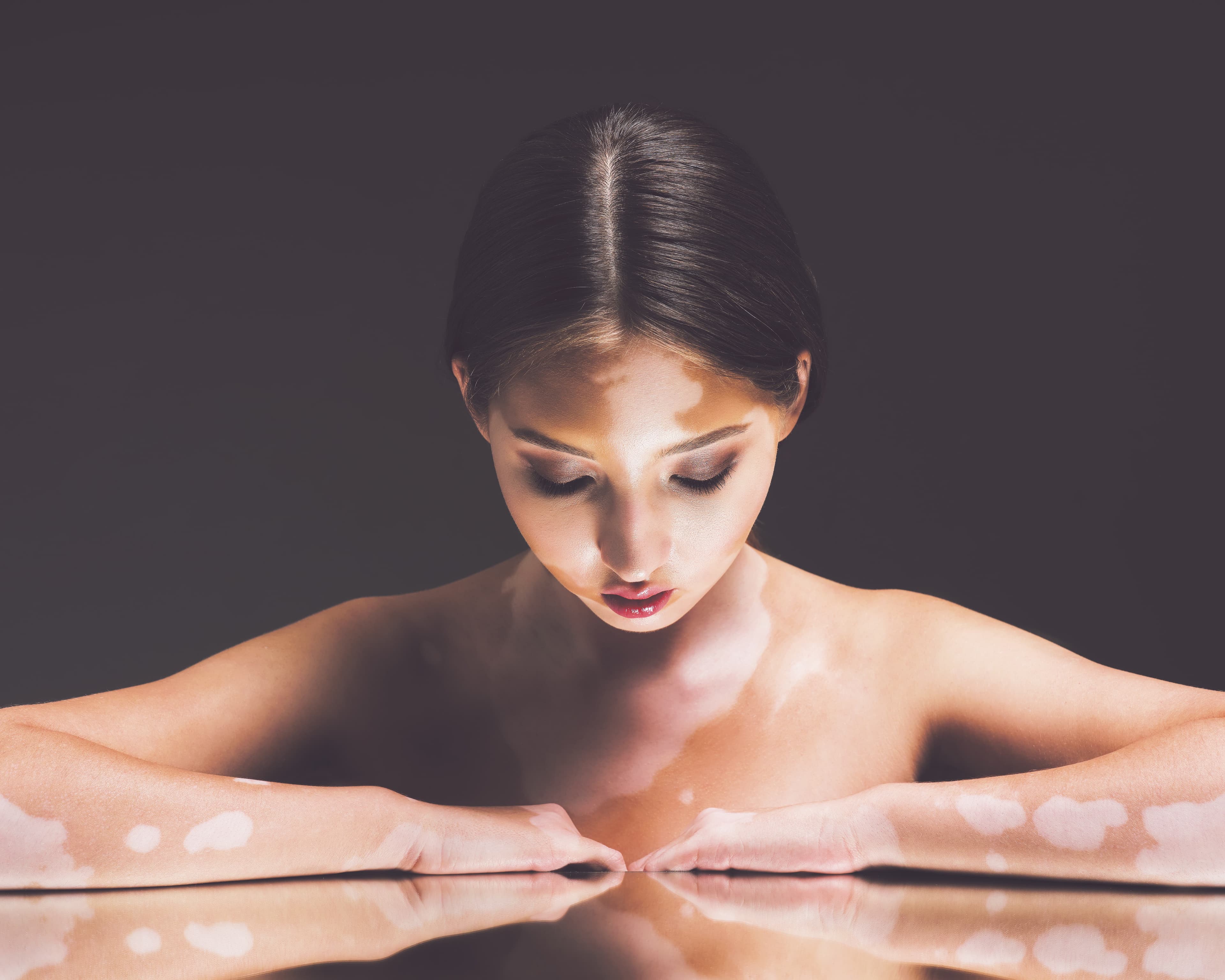 Vitiligo kasalligi haqidagi tasavvurni tubdan oʼzgartira oladigan 8 hikoya