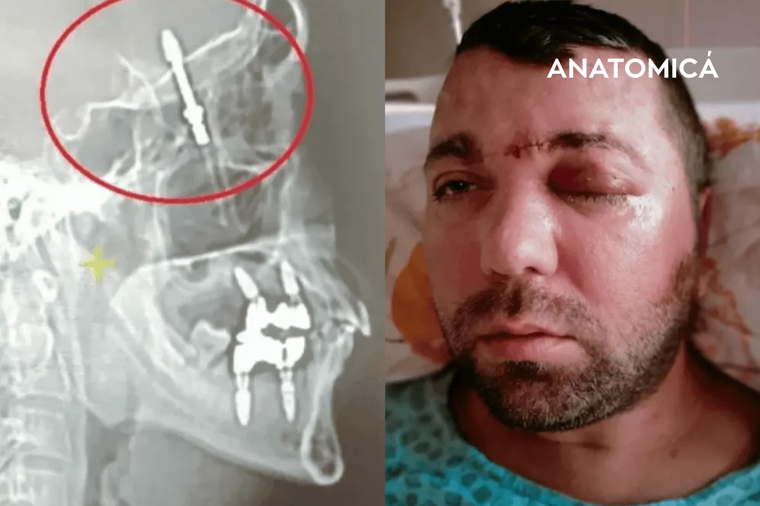 Turkiyada shifokor tish implantini bemorning miyasiga o'rnatib qo'ydi